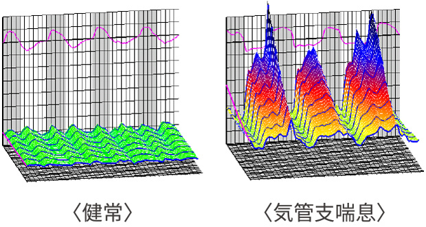 モストグラフ・気管支喘息